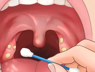 O que podem ser bolinhas brancas na garganta?