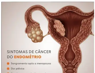 Câncer de endométrio: o que é, sintomas, causas e tratamento