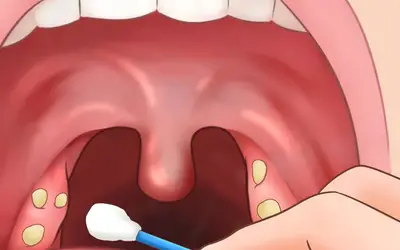 O que podem ser bolinhas brancas na garganta?